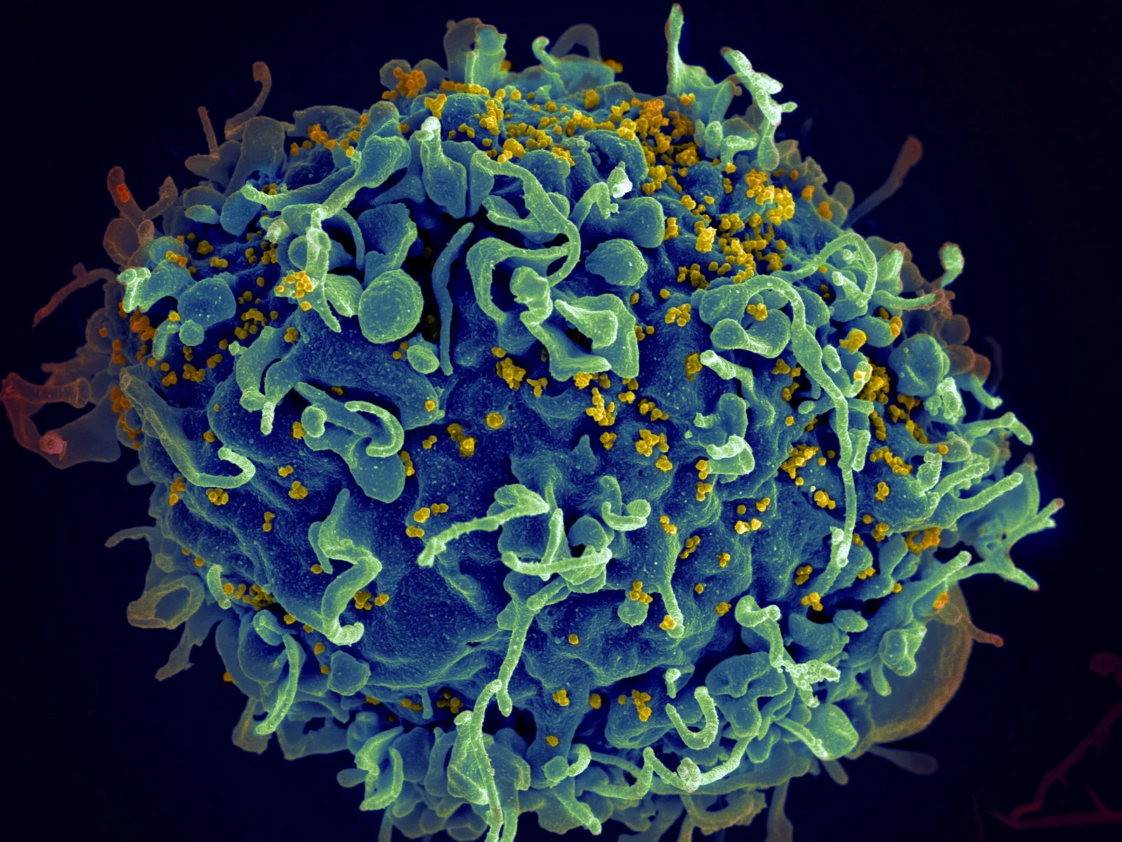 Colorized electron micrograph of a human T cell with HIV particles